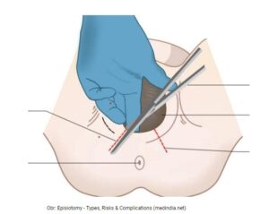  Episiotomy - Types, Risks & Complications (medindia.net) 